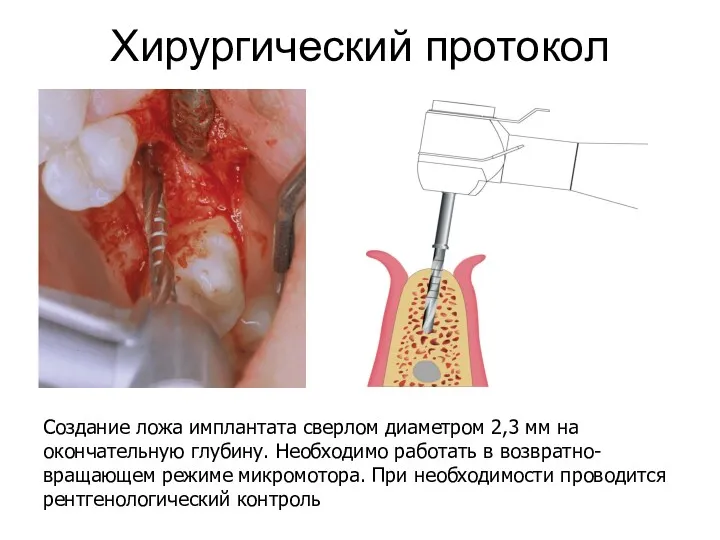 Хирургический протокол Создание ложа имплантата сверлом диаметром 2,3 мм на