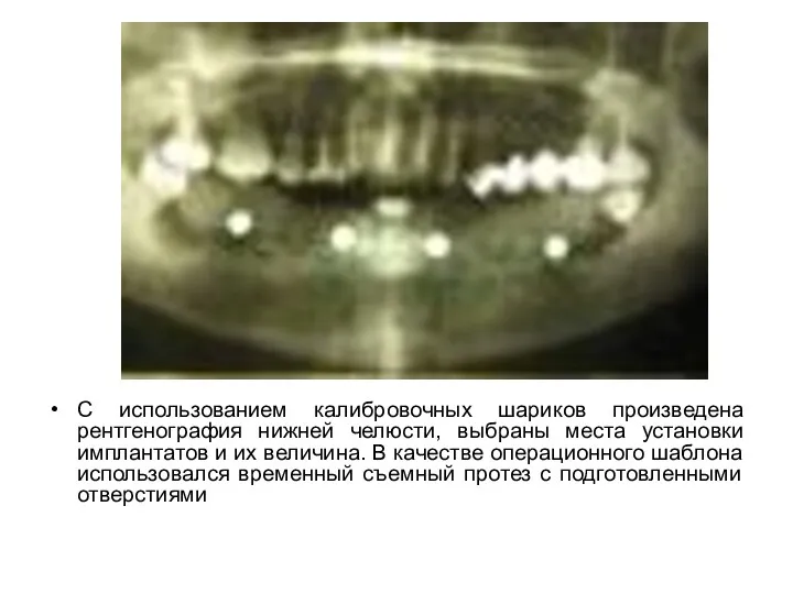 С использованием калибровочных шариков произведена рентгенография нижней челюсти, выбраны места