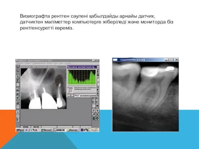 Визиографта рентген сәулені қабылдайды арнайы датчик, датчиктен мәліметтер компьютерге жіберіледі және мониторда біз рентгенсуретті көреміз.