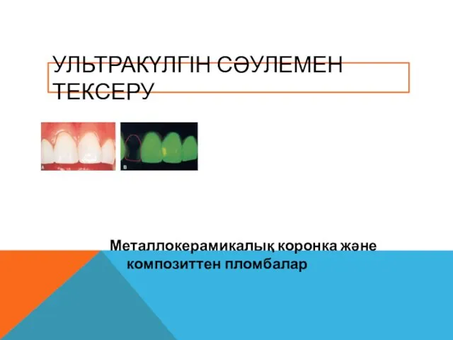 Металлокерамикалық коронка және композиттен пломбалар УЛЬТРАКҮЛГІН СӘУЛЕМЕН ТЕКСЕРУ