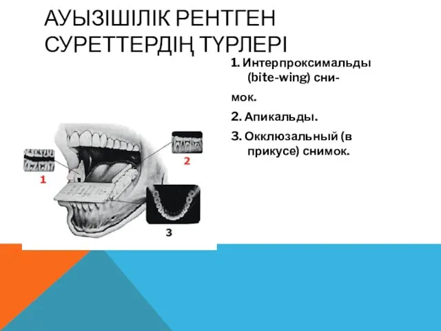 1. Интерпроксимальды (bite-wing) сни- мок. 2. Апикальды. 3. Окклюзальный (в прикусе) снимок. АУЫЗІШІЛІК РЕНТГЕН СУРЕТТЕРДІҢ ТҮРЛЕРІ