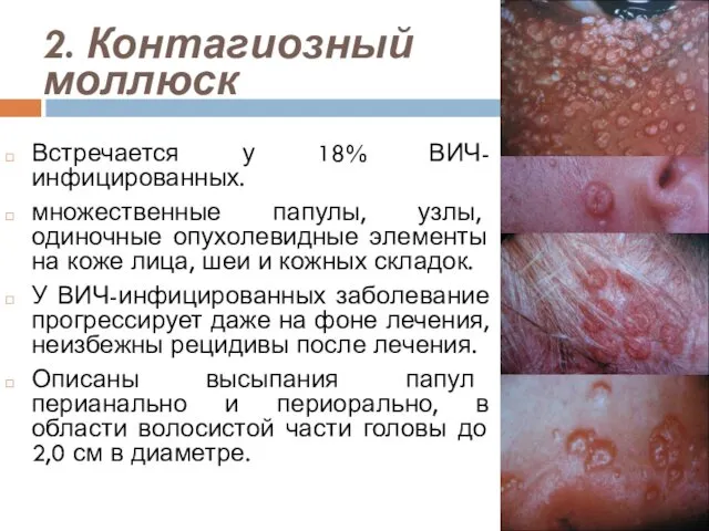 2. Контагиозный моллюск Встречается у 18% ВИЧ-инфицированных. множественные папулы, узлы, одиночные опухолевидные элементы