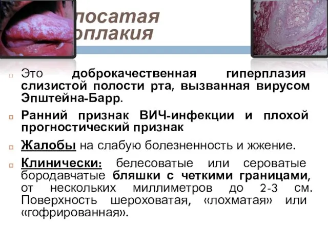 3. Волосатая лейкоплакия Это доброкачественная гиперплазия слизистой полости рта, вызванная