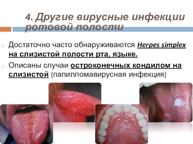 4. Другие вирусные инфекции ротовой полости Достаточно часто обнаруживаются Herpes simplex на слизистой