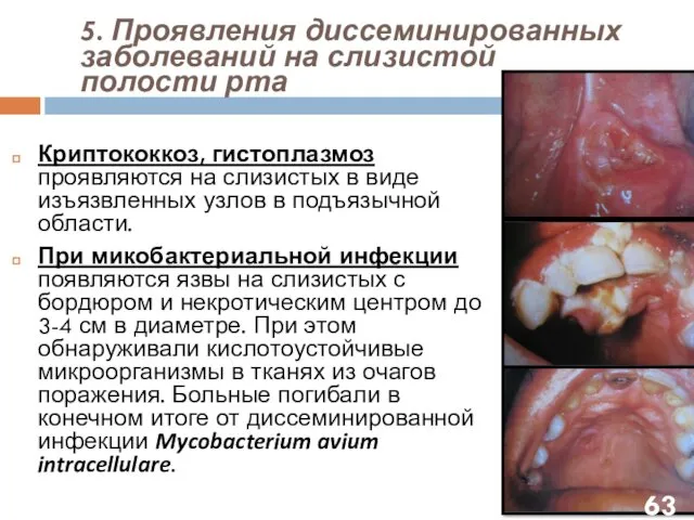 5. Проявления диссеминированных заболеваний на слизистой полости рта Криптококкоз, гистоплазмоз проявляются на слизистых