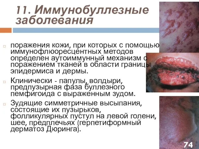 11. Иммунобуллезные заболевания поражения кожи, при которых с помощью иммунофлюоресцентных
