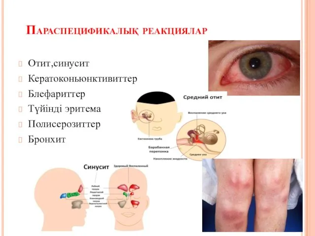 Параспецификалық реакциялар Отит,синусит Кератоконьюнктивиттер Блефариттер Түйінді эритема Полисерозиттер Бронхит