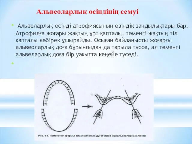 Альвеларлық өсінді атрофиясының өзіндік заңдылықтары бар. Атрофияға жоғары жақтың ұрт