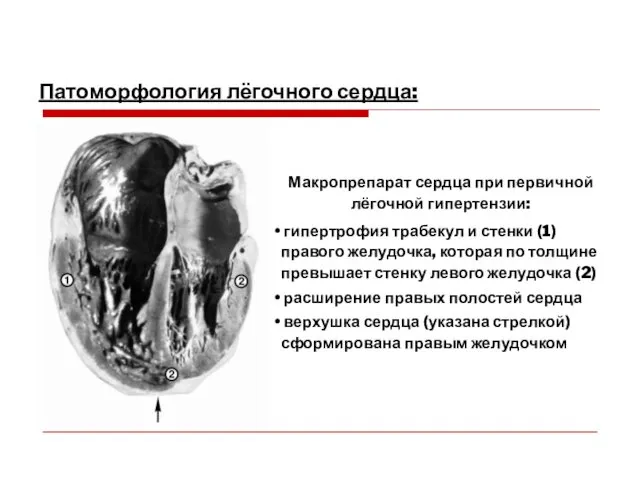 Патоморфология лёгочного сердца: Макропрепарат сердца при первичной лёгочной гипертензии: гипертрофия