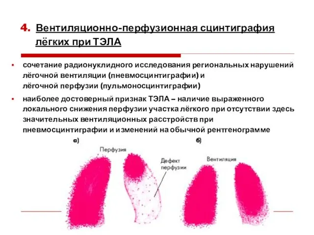 сочетание радионуклидного исследования региональных нарушений лёгочной вентиляции (пневмосцинтиграфии) и лёгочной