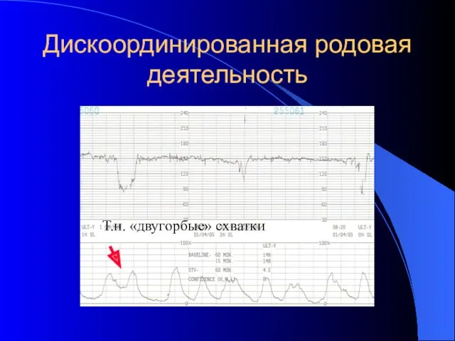 Дискоординированная родовая деятельность Т.н. «двугорбые» схватки