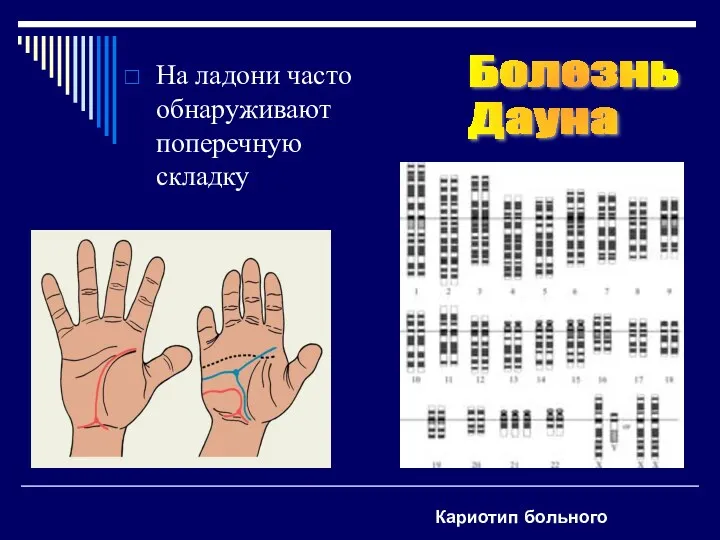 На ладони часто обнаруживают поперечную складку Болезнь Дауна Кариотип больного