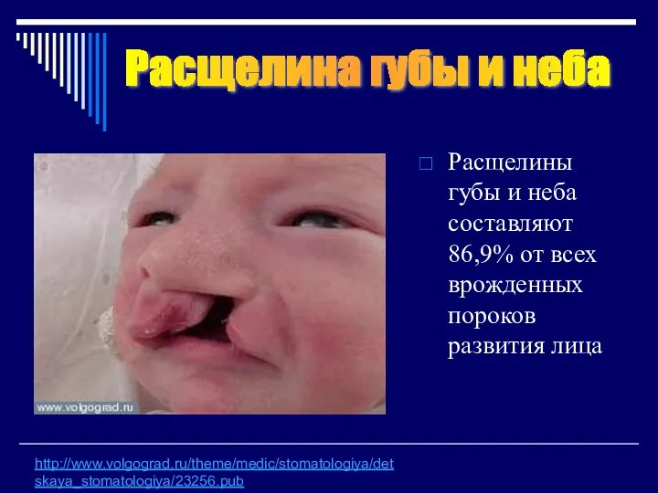 Расщелины губы и неба составляют 86,9% от всех врожденных пороков