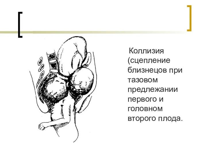 Коллизия (сцепление близнецов при тазовом предлежании первого и головном второго плода.