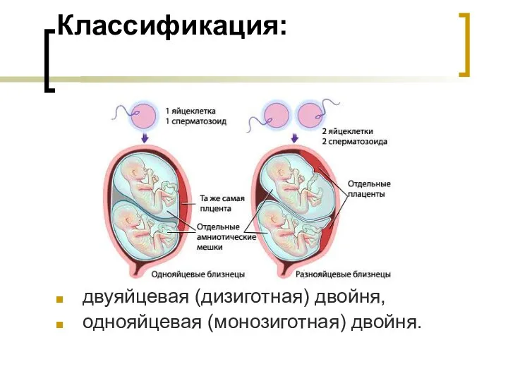 Классификация: двуяйцевая (дизиготная) двойня, однояйцевая (монозиготная) двойня.