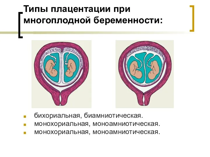Типы плацентации при многоплодной беременности: бихориальная, биамниотическая. монохориальная, моноамниотическая. монохориальная, моноамниотическая.