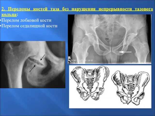 2. Переломы костей таза без нарушения непрерывности тазового кольца: Перелом лобковой кости Перелом седалищной кости