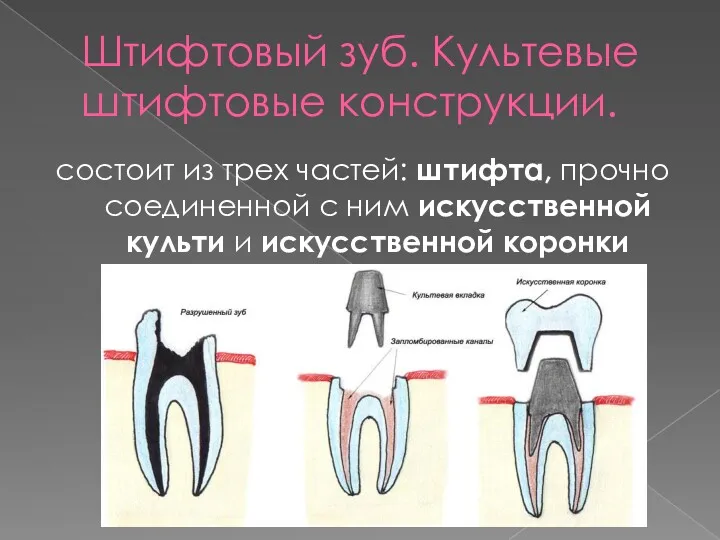 Штифтовый зуб. Культевые штифтовые конструкции. состоит из трех частей: штифта, прочно соединенной с
