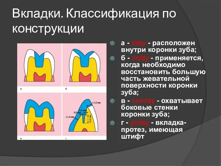 Вкладки. Классификация по конструкции а - inlay - расположен внутри