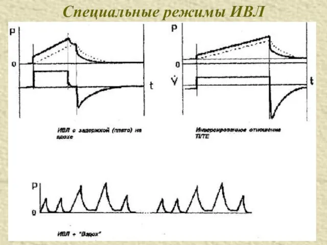 Специальные режимы ИВЛ