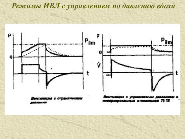 Режимы ИВЛ с управлением по давлению вдоха
