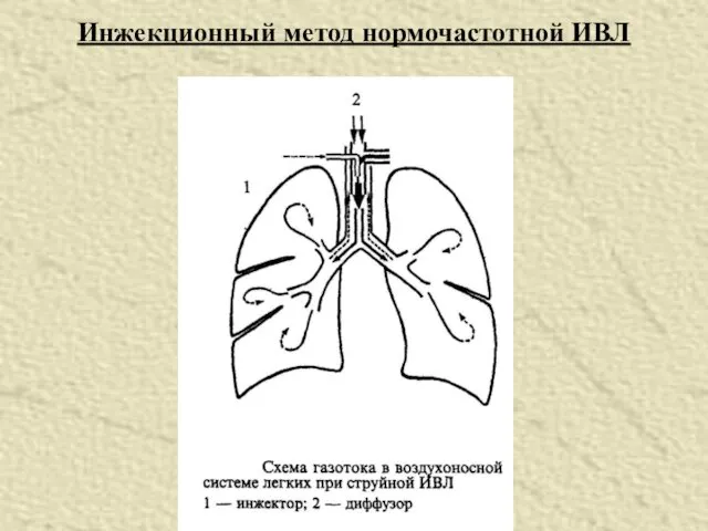 Инжекционный метод нормочастотной ИВЛ