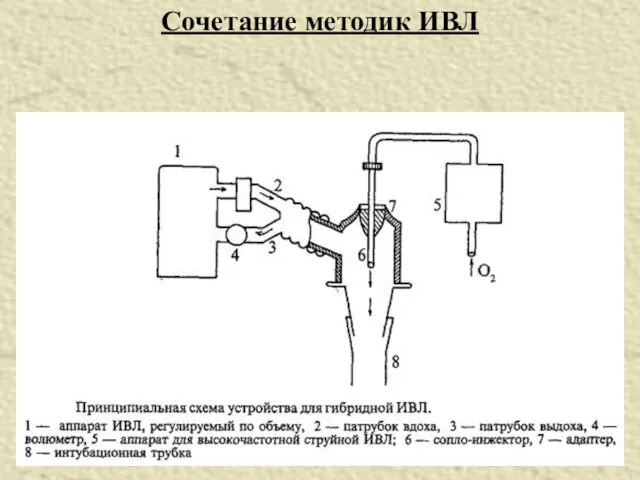 Сочетание методик ИВЛ