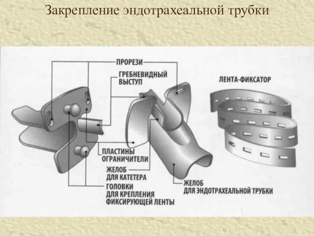 Закрепление эндотрахеальной трубки