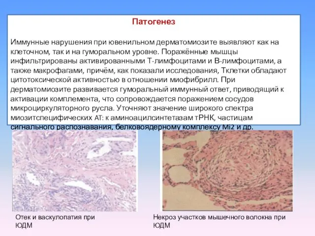 Патогенез Иммунные нарушения при ювенильном дерматомиозите выявляют как на клеточном, так и на