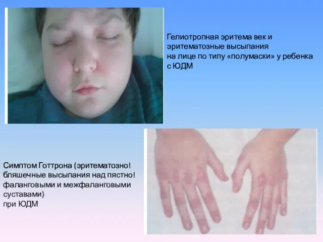 Гелиотропная эритема век и эритематозные высыпания на лице по типу «полумаски» у ребенка