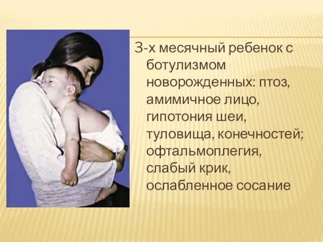 3-х месячный ребенок с ботулизмом новорожденных: птоз, амимичное лицо, гипотония