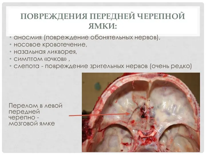 ПОВРЕЖДЕНИЯ ПЕРЕДНЕЙ ЧЕРЕПНОЙ ЯМКИ: аносмия (повреждение обонятельных нервов), носовое кровотечение,