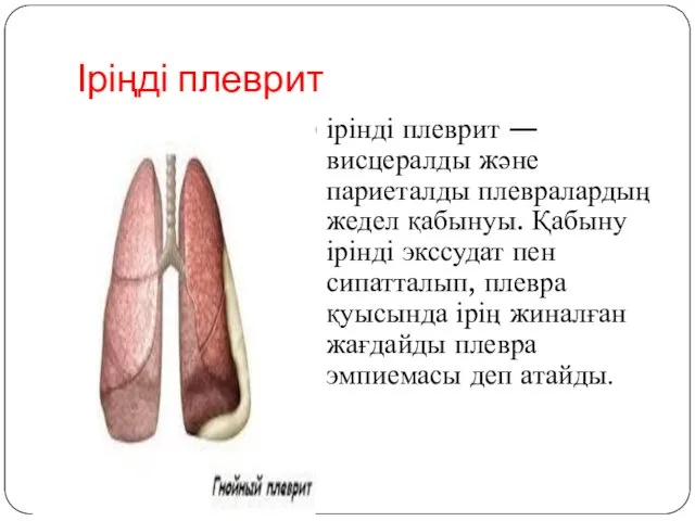 Іріңді плеврит ірінді плеврит — висцералды және париеталды плевралардың жедел қабынуы. Қабыну ірінді