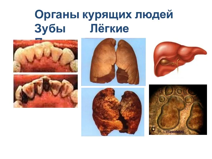 Органы курящих людей Зубы Лёгкие Печень