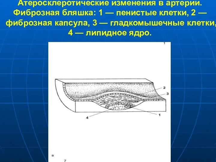 Атеросклеротические изменения в артерии. Фиброзная бляшка: 1 — пенистые клетки,