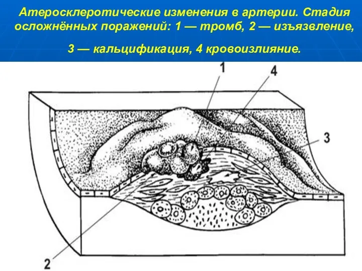 Атеросклеротические изменения в артерии. Стадия осложнённых поражений: 1 — тромб,