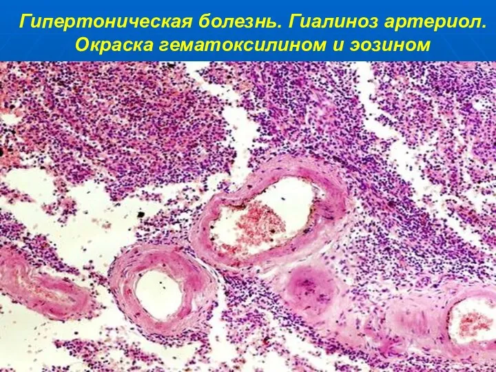 Гипертоническая болезнь. Гиалиноз артериол. Окраска гематоксилином и эозином