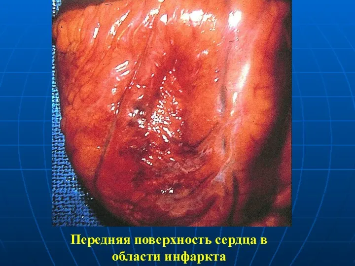 Передняя поверхность сердца в области инфаркта