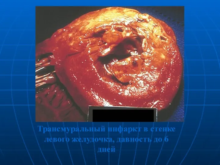 Трансмуральный инфаркт в стенке левого желудочка, давность до 6 дней