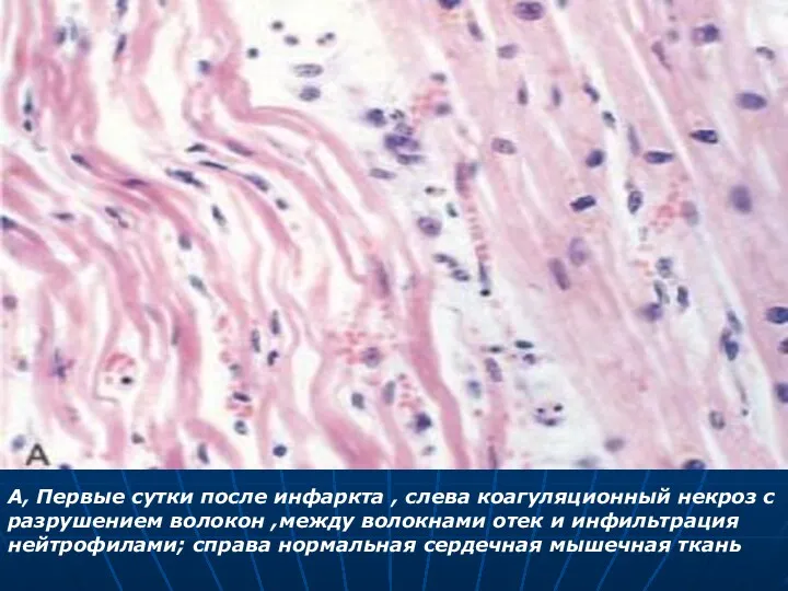 A, Первые сутки после инфаркта , слева коагуляционный некроз с