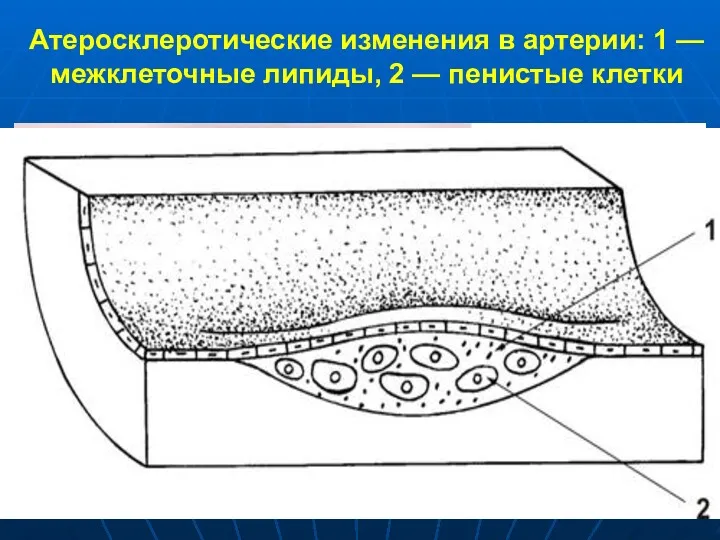 Атеросклеротические изменения в артерии: 1 — межклеточные липиды, 2 — пенистые клетки