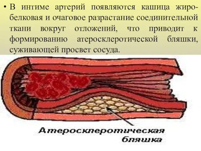 В интиме артерий появляются кашица жиро-белковая и очаговое разрастание соединительной