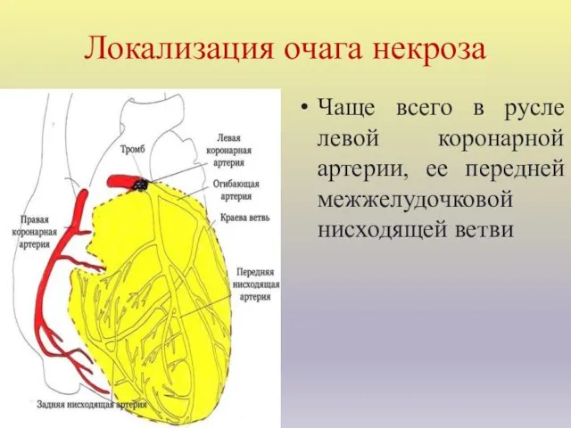 Локализация очага некроза Чаще всего в русле левой коронарной артерии, ее передней межжелудочковой нисходящей ветви