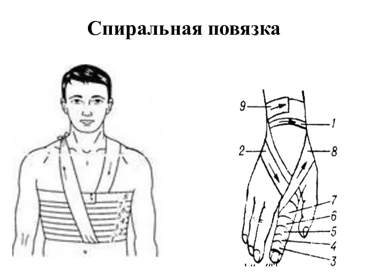 Спиральная повязка