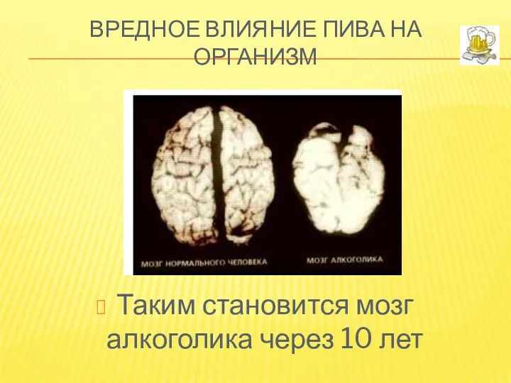 Вредное влияние пива на организм Таким становится мозг алкоголика через 10 лет