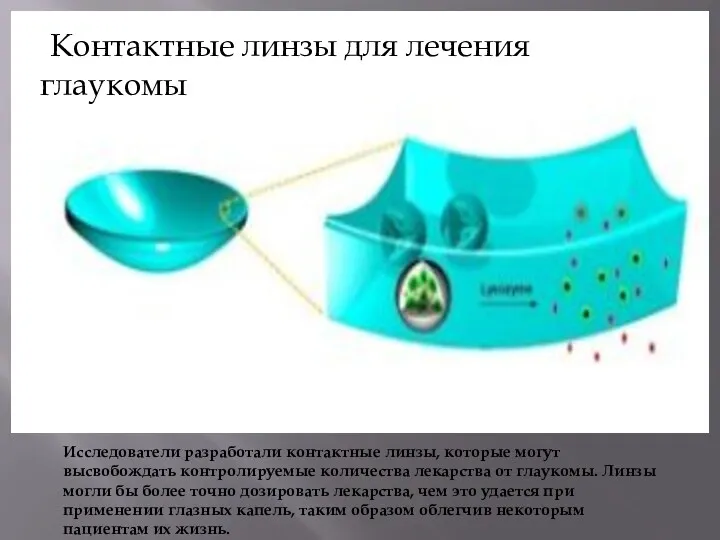 кКонтактные линзы для лечения глаукомы Исследователи разработали контактные линзы, которые