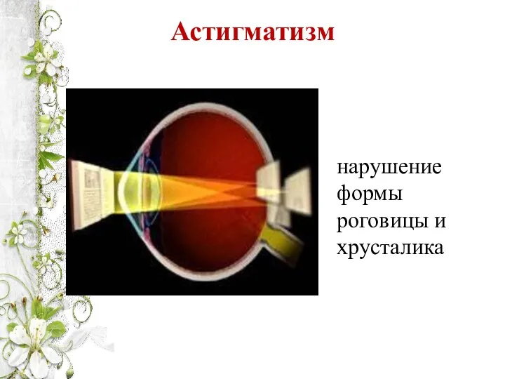 Астигматизм нарушение формы роговицы и хрусталика