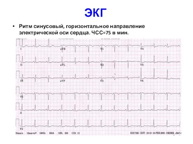 ЭКГ Ритм синусовый, горизонтальное направление электрической оси сердца. ЧСС=75 в мин.