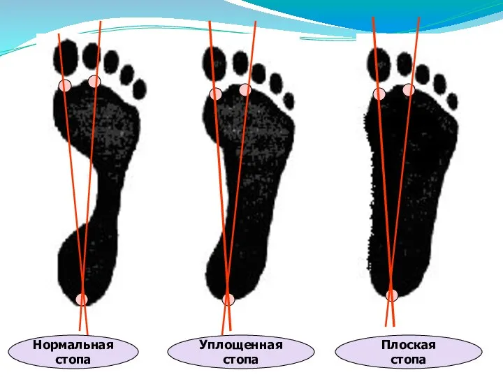 Нормальная стопа Уплощенная стопа Плоская стопа