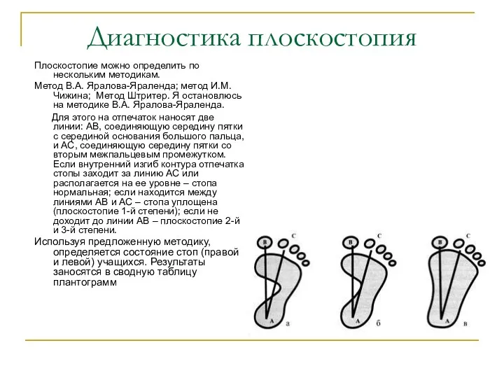 Диагностика плоскостопия Плоскостопие можно определить по нескольким методикам. Метод В.А. Яралова-Яраленда; метод И.М.